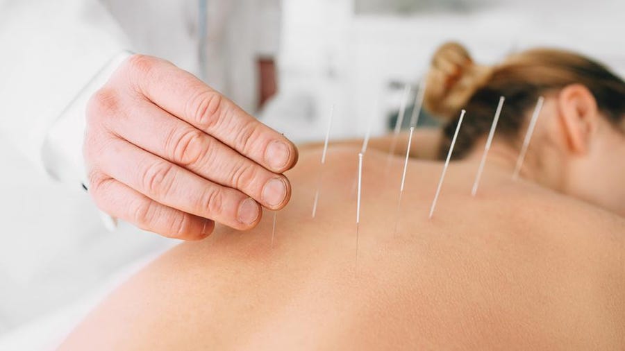 Why People Use Professional Acupuncture For Immediate Relief?