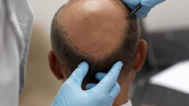 FUE Hair Transplant-The Most Efficient Way to Tackle Hair Fall
